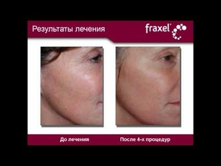 Fraxel - результаты лечения