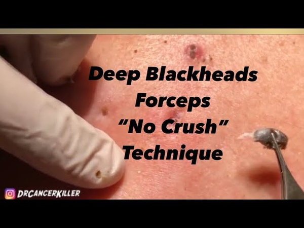 Blackhead REVENGE Part 1 of 3 (part 2 will be published 6, 15, 19 subscribe to see