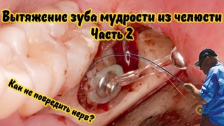 Вытягиваем зуб мудрости для последующего удаления без травмы для нерва / Wisdom tooth extrusion
